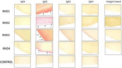 Corrigendum: IgG2 rules: N-acetyl-β-D-glucosamine-specific IgG2 and Th17/Th1 cooperation may promote the pathogenesis of acute rheumatic heart disease and be a biomarker of the autoimmune sequelae of Streptococcus pyogenes